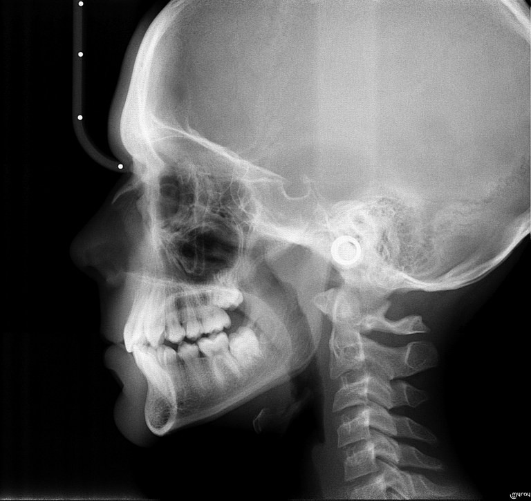 Ортодонтия. Боковая телерентгенограмма – цефалометрическое исследование