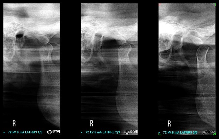 Гнатология. Боковая проекция с открытым ртом (рентгенография височно-нижнечелюстного сустава)