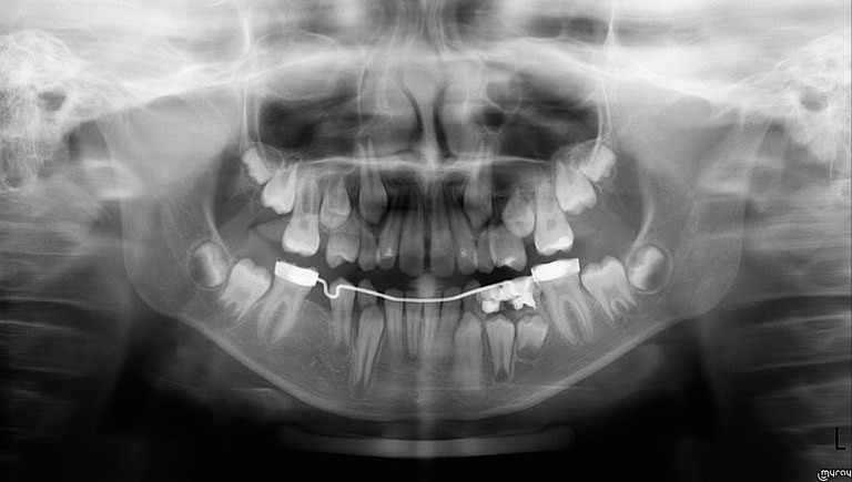 Ортодонтия. Панорамный детский снимок смешанного прикуса – исследование молочных зубов при ортодонтическом лечении. Агенезия зубного зачатка №45 у ребенка, носящего брекеты