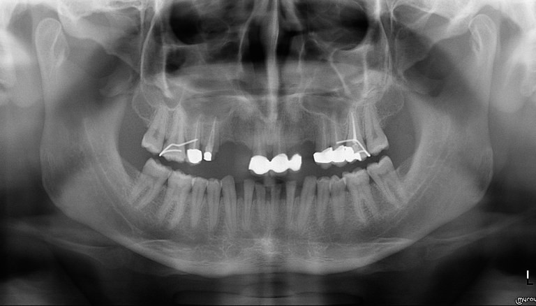 Хирургия. Панорамный снимок челюсти взрослого пациента. Исследование удаления зубов в верхней челюсти