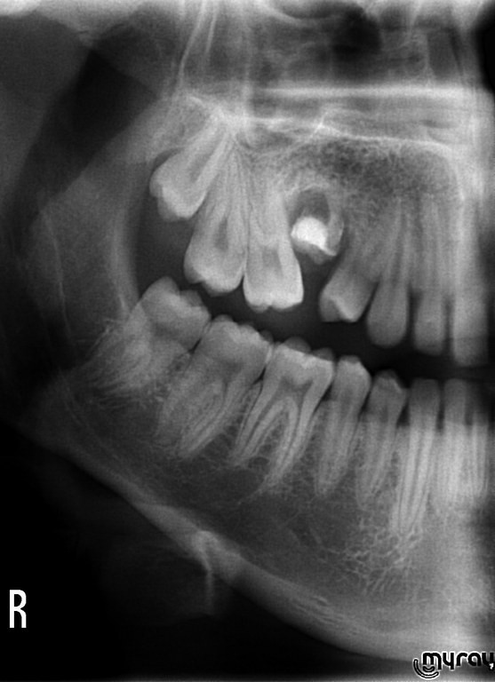 Хирургия. Оценка расположения правых премоляров по отношению к соседним зубам.