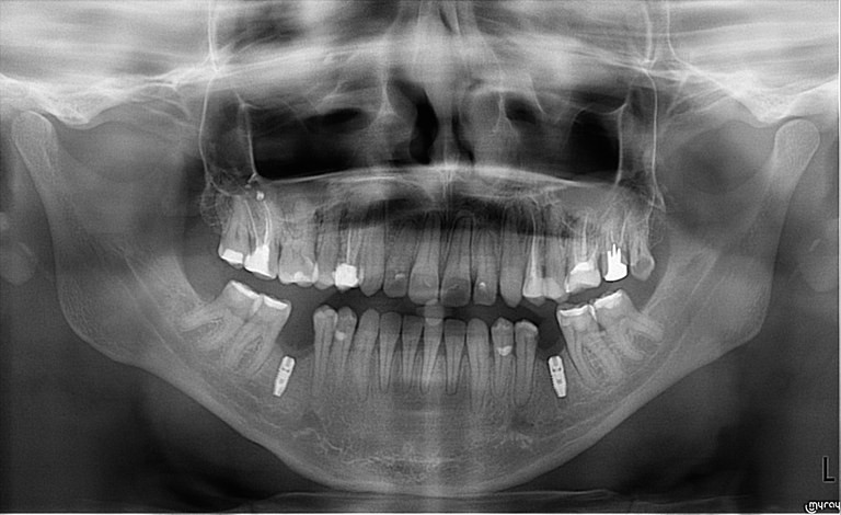 Имплантология. Панорамный снимок всех зубов – нижнечелюстных имплантов, правильное их позиционирование и остеоинтеграция