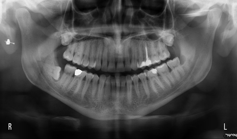 Хирургия. Общий панорамный снимок - оценка ретенированного моляра и подозрение на поражение дистального корня 37 зуба. Дизодонтоз нижнего правого третьего моляра (48-й зуб)