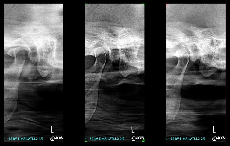 Гнатология. Боковая проекция с закрытым ртом (рентгенография височно-нижнечелюстного сустава)